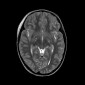 Кавернозная венозная мальформация головного мозга Диффузное аксональное повреждение головного мозга (ДАП)