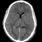Геморрагический ушиб головного мозга Диффузное аксональное повреждение. Черепно-мозговая травма, ДТП.