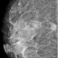 BI-RADS IV категории Рак молочной железы BI RADS 4