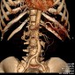 Аневризма печеночной артерии Псевдоаневризма селезеночной артерии