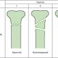 Классификация переломов трубчатых костей Мюллера АО (Ассоциации Осетосинтеза) Рис 5 Виды сегментарных переломов