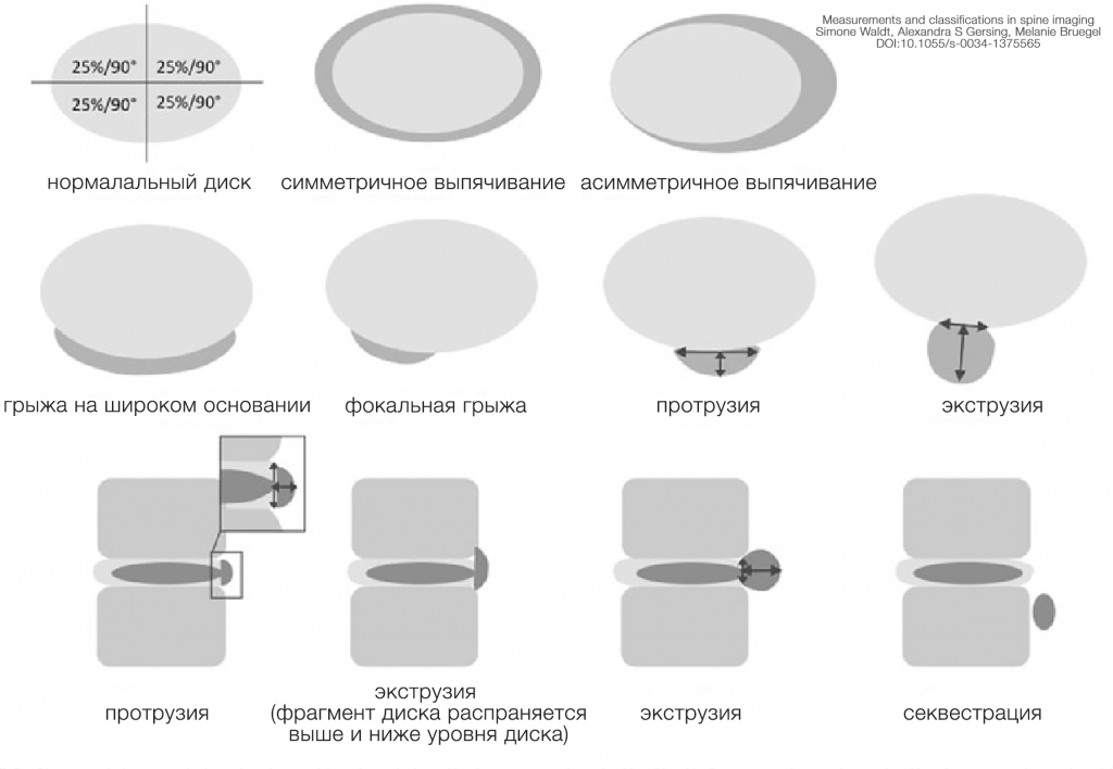Номенклатура и классификация патологий межпозвонковых дисков