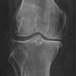Остеоартрит коленного сустава, классификация Kellgren и Lawrence III стадия