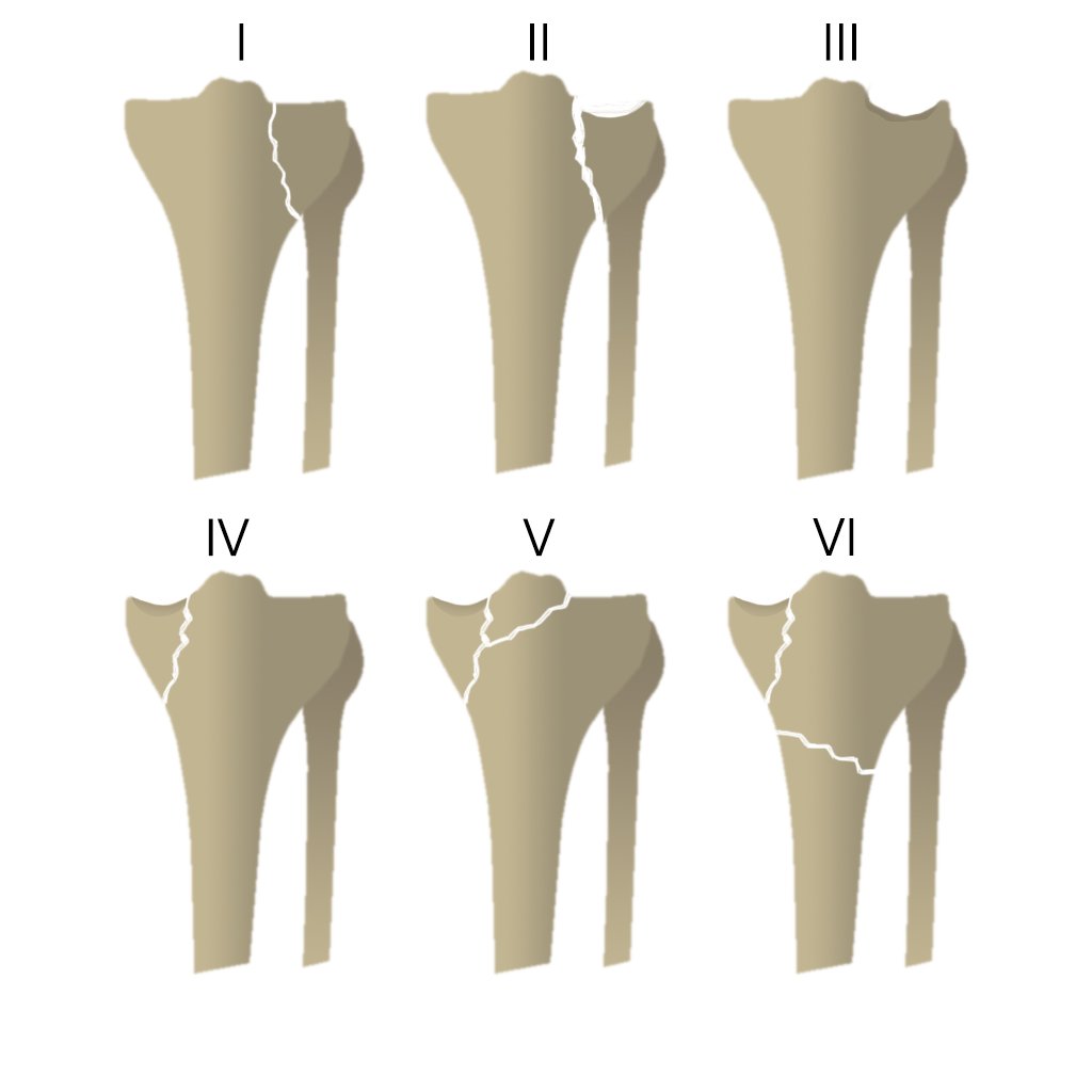 Переломы плато большеберцовой кости (классификация Шацкера Schatzker)