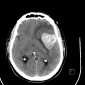 Аневризма сосудов головного мозга Гиганская тромбированная мешотчатая аневризма