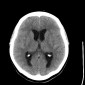 Аневризма сосудов головного мозга Субарахноидальное кровоизлияние