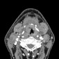 Рак глотки Рак ротоглотки с распространением на надскладочный и складочный отдел гортани