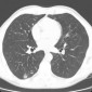 Туберкулез легких Исход кавернозного туберкулеза легких (Cavernous pulmonary tuberculosis  outcome)