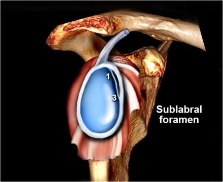 Сухожилие надостной мышцы плеча мрт thumbnail