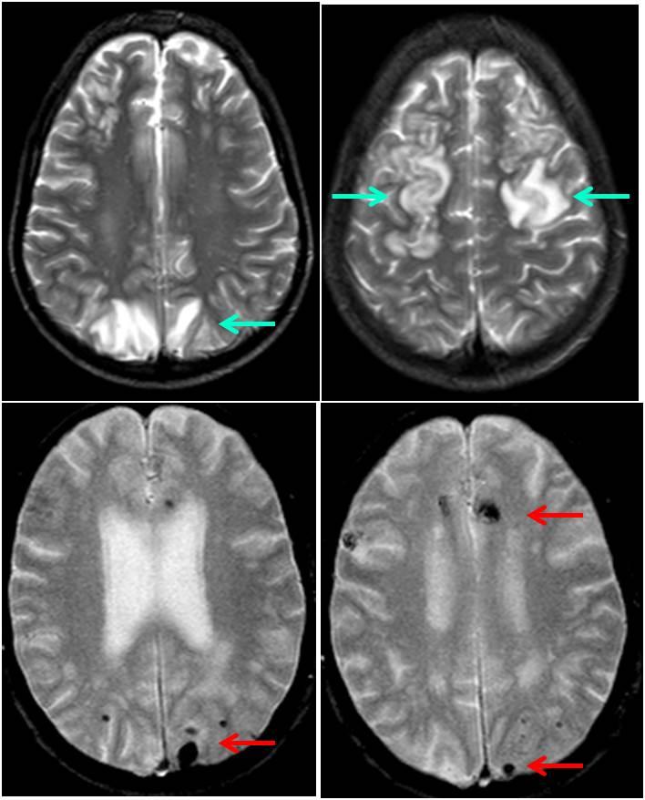 МРТ снимки головного мозга новорожденных