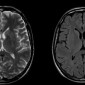 Метастатические опухоли головного мозга МРТ Головного мозга. Состояние после радиохирургии
