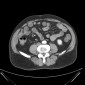 Язвенная болезнь Язвенная болезнь желудка, карциноидные опухоли тощей кишки с мтс в брыжеечном лимфоузле (Peptic ulcer, Carcinoid tumors of the jejunum with mets  in mesenteric lymph nodes)