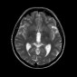 Классификация церебральных кавернозных мальформаций Zabramski J.M. Кавернозная венозная мальформация среднего мозга