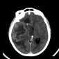 Аневризма сосудов головного мозга Глиобластома височной доли справа. Аневризма ВСА справа. Петрокливальная менингиома слева