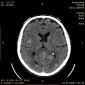 Абсцесс головного мозга Метастазы головного мозга