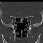 Энцефалоцеле Аберрантные пахионовы грануляции большого крыла клиновидной кости