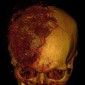 Дислокация мозга под большой серповидный отросток Остеосаркома* свода черепа