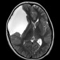Дислокация мозга под большой серповидный отросток Арахноидальная киста