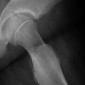 Перелом кости Юношеский эпифизеолиз головки бедренной кости (ЮЭГБК)