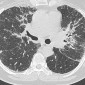 Неспецифическая интерстициальная пневмония (НСИП) НСИП паттерн при саркоидозе