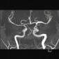 Фетальный тип строения задней мозговой артерии Персистирующая тригеминальная артерия. Фетальный тип строения правой задней мозговой артерии. 
