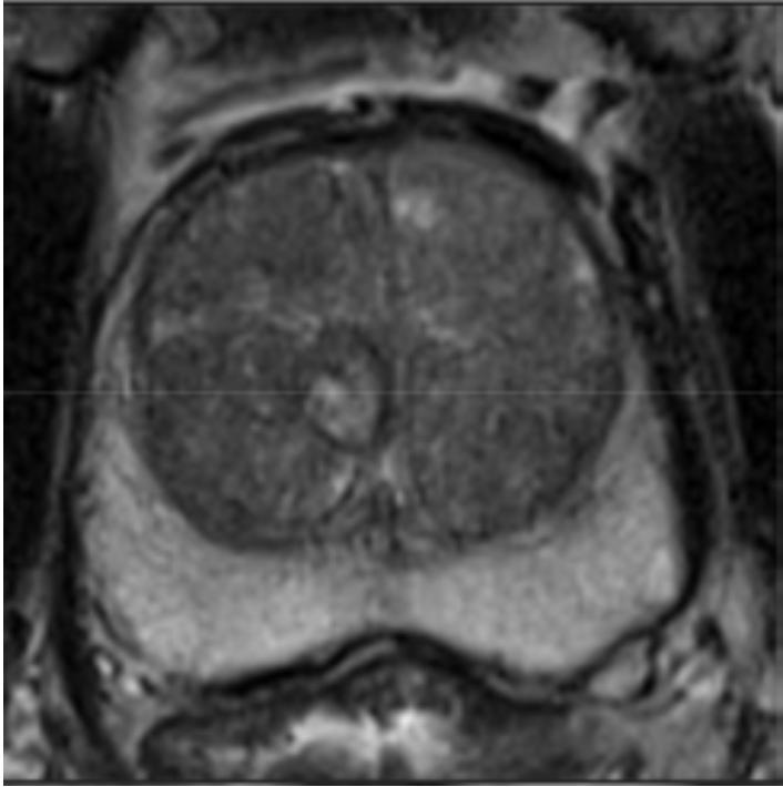Cancer de prostata t2, Imagistica prin Rezonanta Magnetica (IRM) in cancerul prostatic