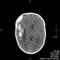 Геморрагический ушиб головного мозга Открытая  черепно - мозговая травма. Субдуральная и внутримозговая гематома.