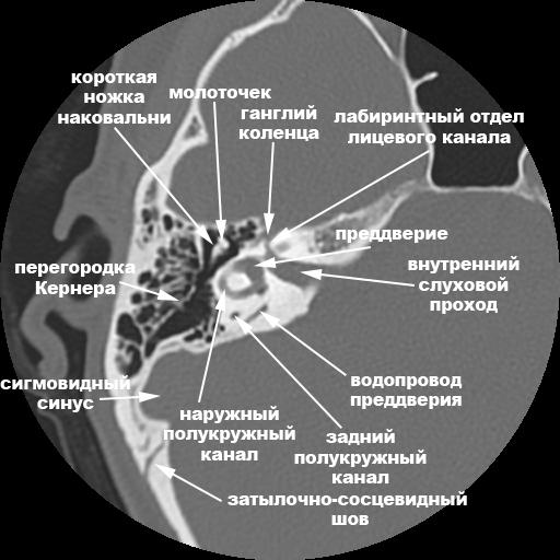 Пирамида височной кости KT : нормальная анатомия | e-Anatomy