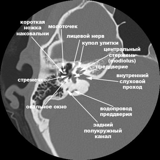 Височная кость (анатомия при компьютерной томографии)