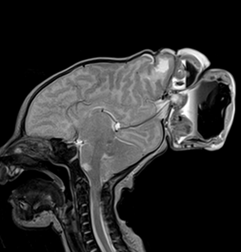 Задняя черепно-мозговая грыжа (энцефалоцистоменингоцеле)