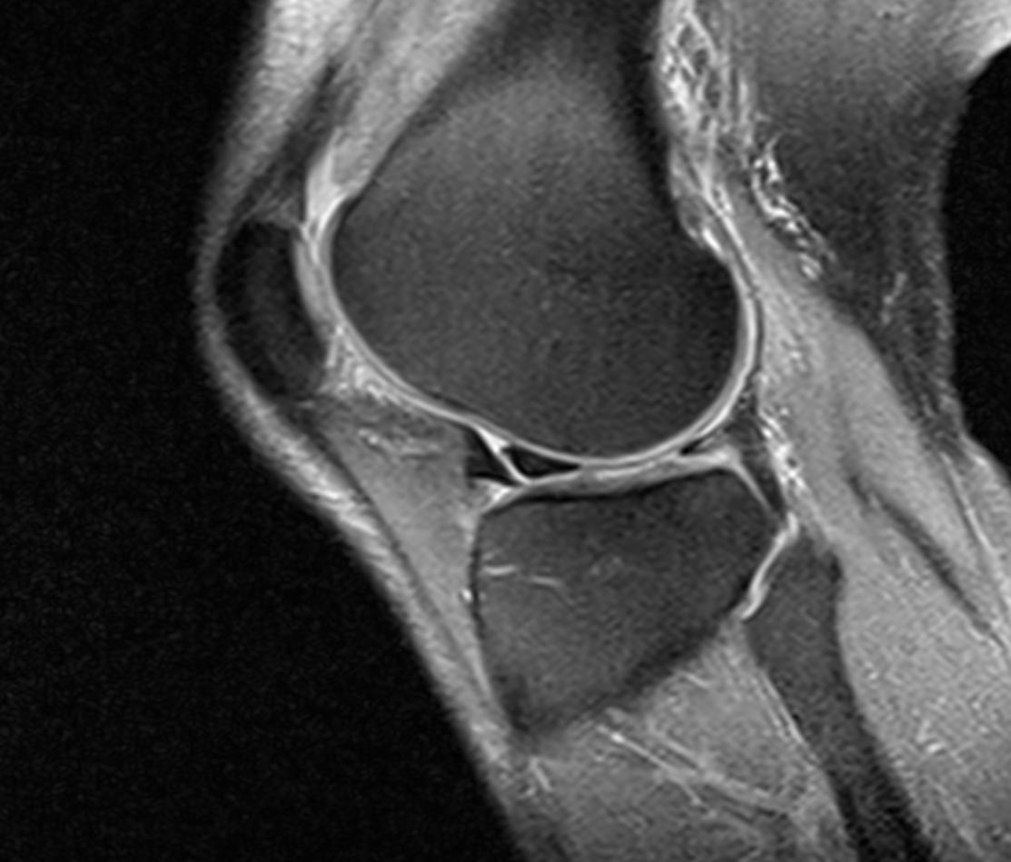 Смещенный разрыв по типу "ручки лейки" (displaced bucket handle tear / flipped meniscus)