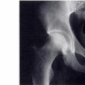 Асептический некроз головки бедренной кости, классификация по Steinberg 0 стадия