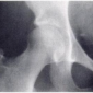 Асептический некроз головки бедренной кости, классификация по Steinberg I стадия