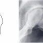 Асептический некроз головки бедренной кости, классификация по Steinberg III стадия