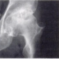 Асептический некроз головки бедренной кости, классификация по Steinberg VI стадия