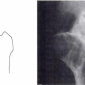 Асептический некроз головки бедренной кости, классификация по Steinberg V  стадия