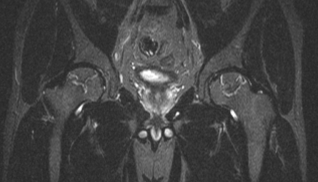 Асептический некроз головок бедренных костей (Bilateral avascular necrosis of the hip).