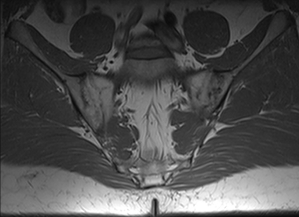      Romanus lesions