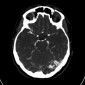 Артериовенозная мальформация Артерио-венозная мальформация головного мозга (АВМ)