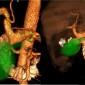 Аневризма печеночной артерии Рис 3