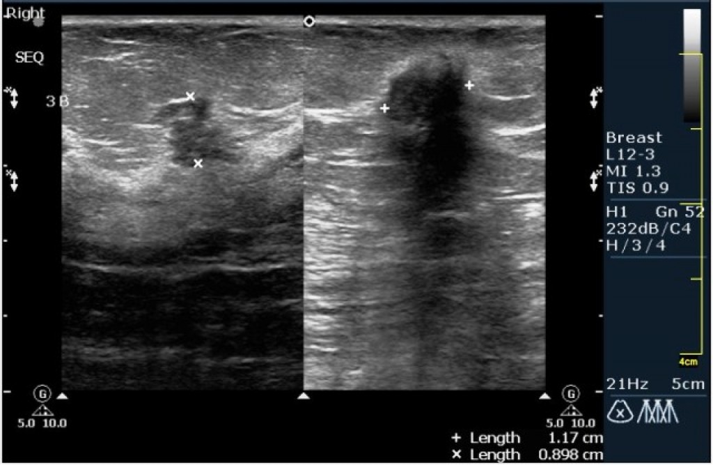 Кисты молочных желез bi rads 2. УЗИ гематома молочных желез. Гематома молочной железы на УЗИ. Сегменты молочной железы на УЗИ. Гематома правой молочной железы.