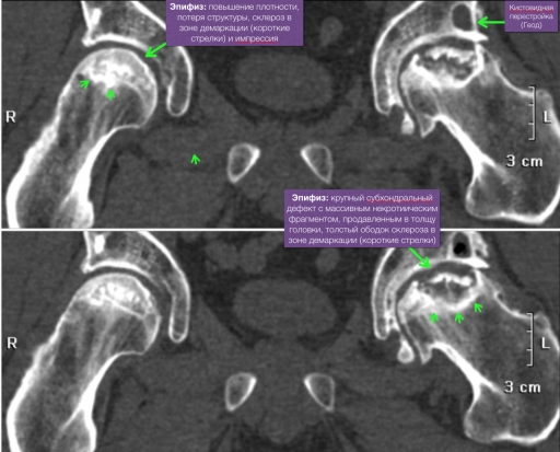 Асептический некроз на кт головки бедренной. Асептический некроз тазобедренного сустава на кт. Асептический некроз вертлужной впадины тазобедренного сустава мрт. Коксартроз тазобедренного сустава кт. Асептический некроз вертлужной впадины кт.