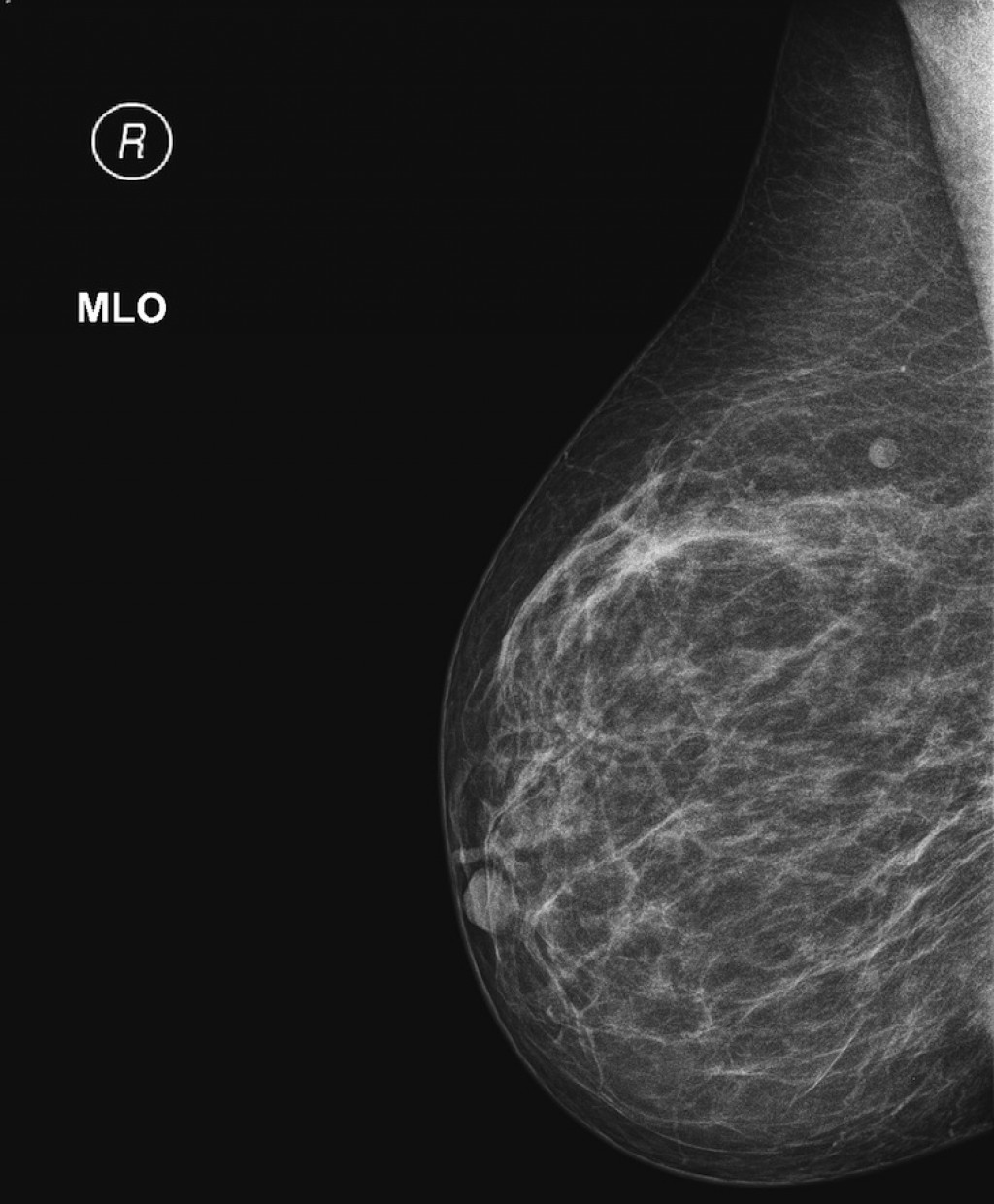 Кисты bi rads 2. Доброкачественная опухоль молочной железы. Доброкачественные новообразования груди. D24 доброкачественное новообразование молочной железы ВПП слева.