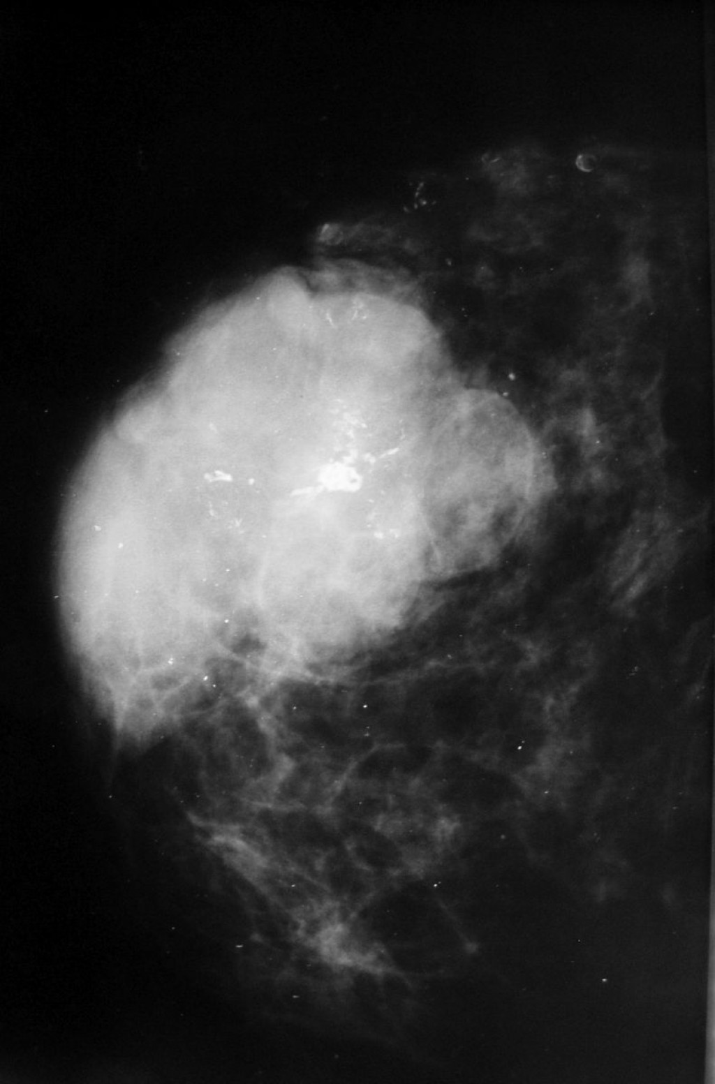 Аденоз на маммографии. Склерозирующий аденоз маммография. Фиброаденома молочной железы маммография. Аденоз молочных желез на маммографии.