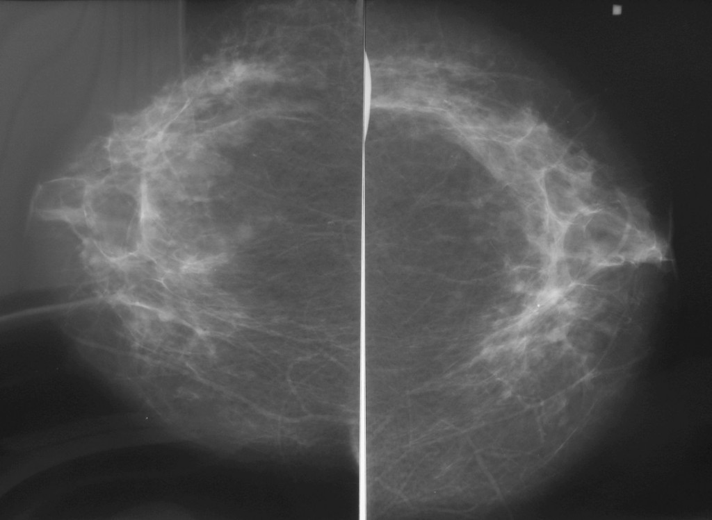 Маммография старый. Маммография. Маммография молочных желез. Здоровый снимок маммографии.