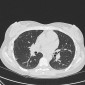 Неспецифическая интерстициальная пневмония (НСИП) НСИП паттерн при синдроме Шегрена