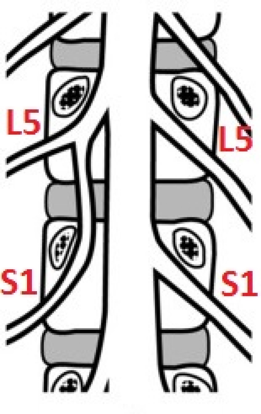 Conjoined nerve root (L5-S1)
