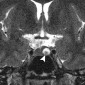 Внутричерепные образования с высоким сигналом на Т1 взвешенных изображениях: дифференциальная диагностика Рис 12a
