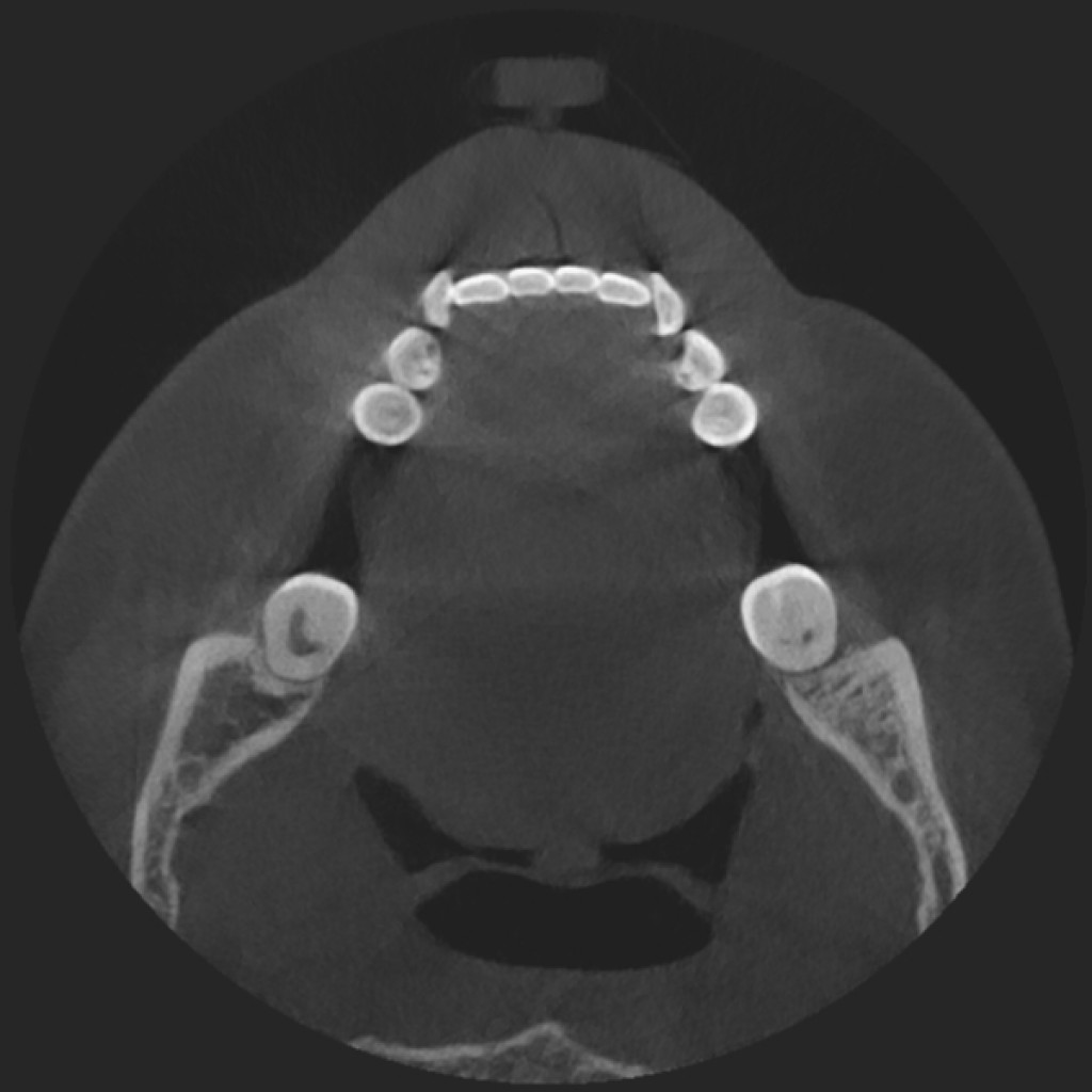 Реферат по теме Травматический остеомиелит нижней челюсти справа,очаговый, без консолидации