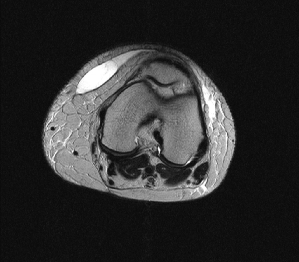 Повреждение Морель-Лавалле, область коленного сустава (Morel Lavallée lesion of the knee) Повреждение Морель-Лавалле, область коленного сустава (Morel Lavallée lesion of the knee)